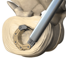 NLT Spine drawing of spinal fusion surgery device